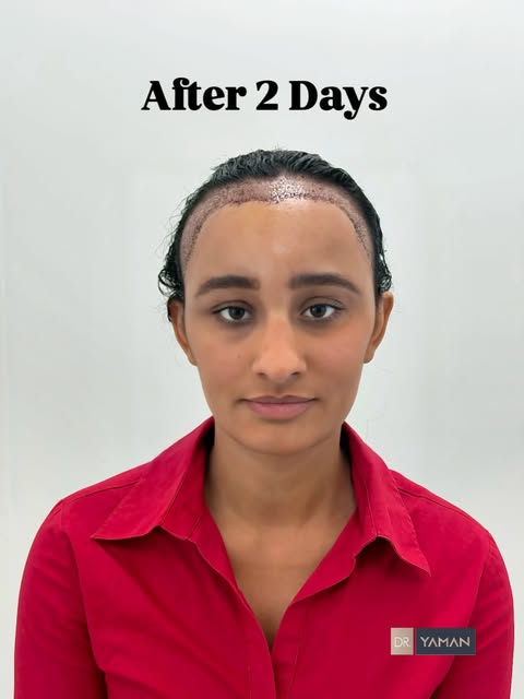 3700 Grafts for Frontal Hairline Restoration | Female Hair Transplant
A young female patient from Po