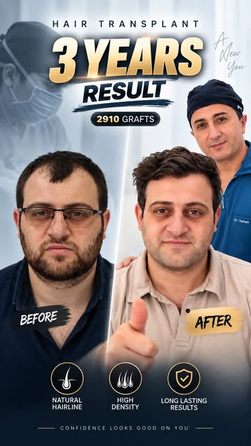 Three years after a 2910-graft frontal hair transplant, this patient can style his hair without worr