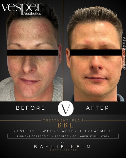 One treatment, one noticeable difference. ✨ 

BBL works by using light-based technology to target su