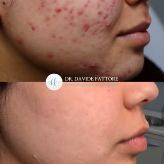 L’acne non è solo un problema estetico.
Può lasciare segni sulla pelle, ma anche sulla sicurezza in 