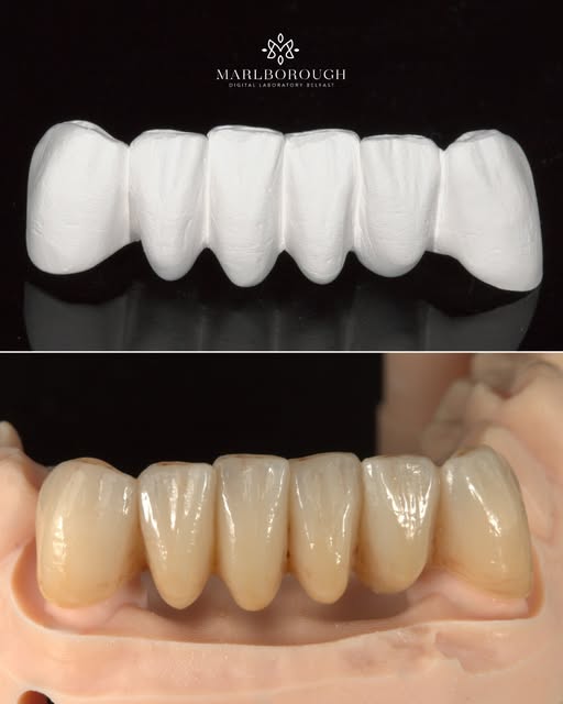 A conventional lower zirconia bridge, with green state carving carried out before sintering to intro