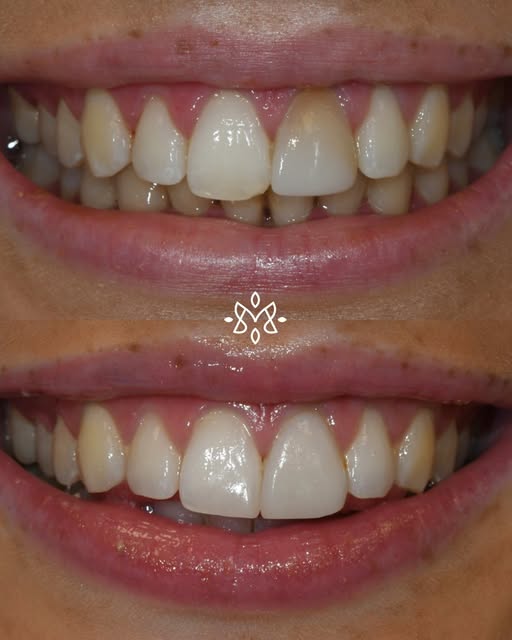 A minimally invasive approach following dental trauma 🦷

A great result for this patient following 