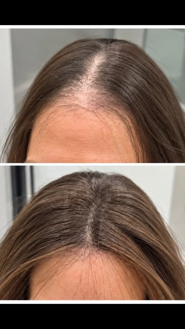 Frontal hair loss can be one of the hardest areas to conceal, which is exactly why the details matte