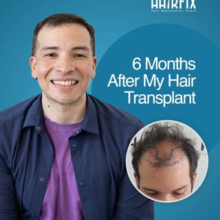 After years of hiding his hair loss under hats, Bryant was ready for change. Six months after his ha