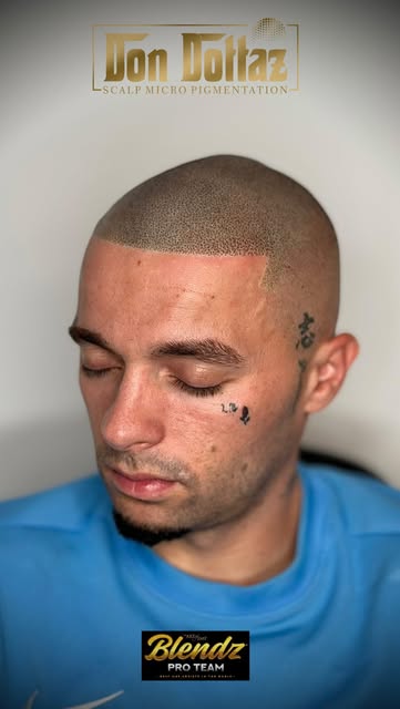 SMP BARBER STYLE 💈
2ND SESSION RESULTS.

#smp #scalpmicropigmentation #hairtattoo #hairline #art