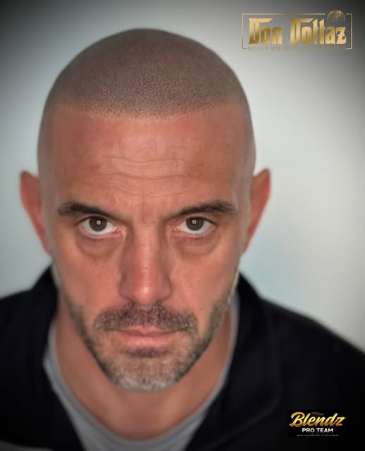 SMP AFTER A HAIR TRANSPLANTS 🪄✨
1ST SESSION RESULTS. 

THIS GENTLEMAN HAD TWO HAIR TRANSPLANTS BUT 