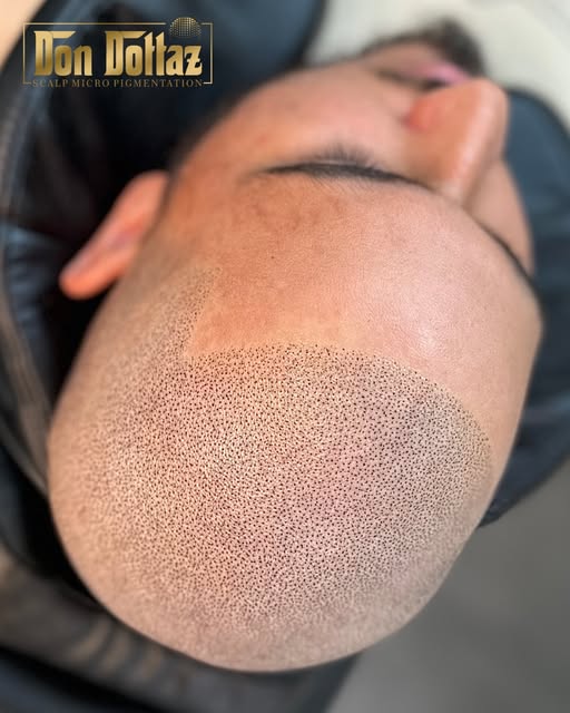 BEFORE & AFTER SMP🪄✨
1ST SESSION RESULTS. 
SHAPE UP STYLE💈

THESE AMAZING RESULTS WERE MADE POSSIB