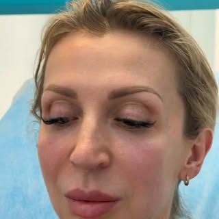 Efekt po 14 dniach
FullFace Clinic - Po Twojej stronie.

👩‍⚕️ Medycyna estetyczna pod kontrolą USG
