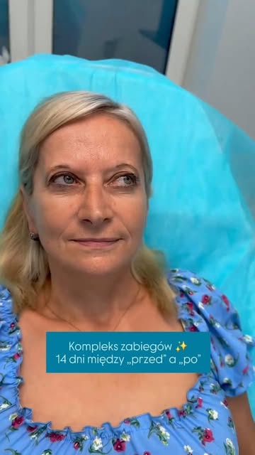 Kompleks zabiegów 💫
14 dni między "przed" a "po"