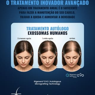 Queda de Cabelo? Perda de Densidade? Atue antes da sua calvície começar a avançar!
Utilizando as sua