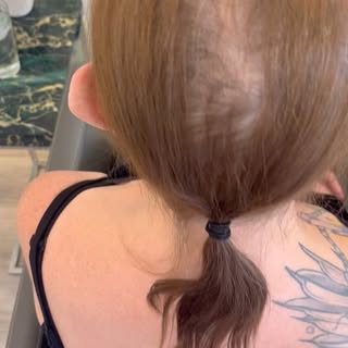 Sister one ❤️❤️❤️❤️
Before and after #hairloss #wigs #ffa #escapehairloss #hairlosssolution #chemoth