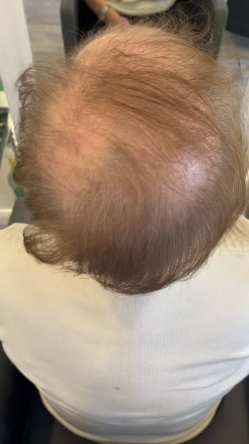 Just add a topper for a complete transformation 
❤️❤️❤️❤️❤️❤️❤️❤️
www.escapehairloss.ie
Contact Mary