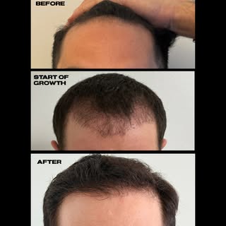 Trust the process! 2000 graft FUE Hair Transplant using the WAW by Dr. Julie de la Cruz. Before, 3 m