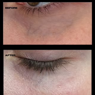 Beauty is in the eye of the beholder 👀 another beautiful result of a vascular laser treatment for u