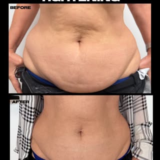 Wow 🙀 abdominal tightening after 1 session with noninvasive radiofrequency! No downtime, no editing