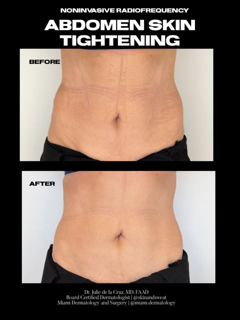 Non invasive skin tightening using combination bipolar and monopolar Radiofrequency Density by @jeis