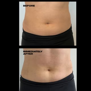Noninvasive skin tightening using a combination of bipolar and monopolar Radiofrequency. This photo 