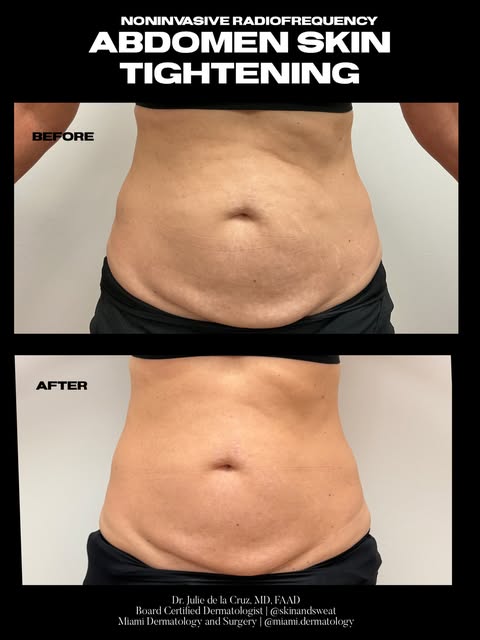 Non invasive skin tightening of the abdomen with Radiofrequency. 😍 using the @jeisys_us combined bi