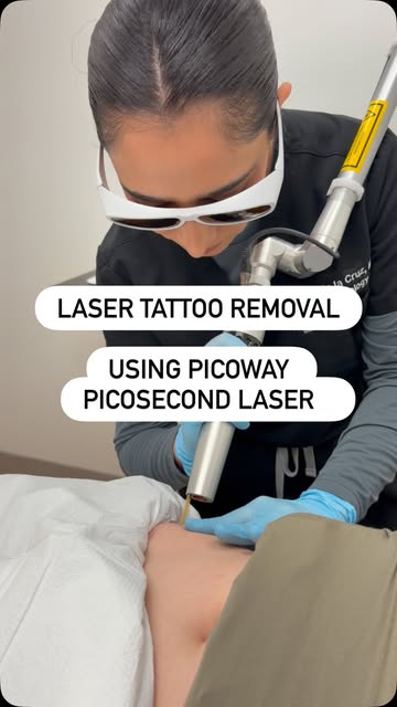 Tattoo removal using picosecond laser. Here we are using the Picoway by @candelamedical 

Schedule y