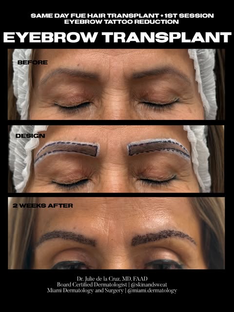 Replacing tattoo with hair. This is what the healing looks like 2 weeks out from an Eyebrow transpla