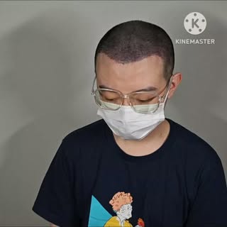 Understanding the challenges of an over-harvested hair transplant donor area is key to finding effec
