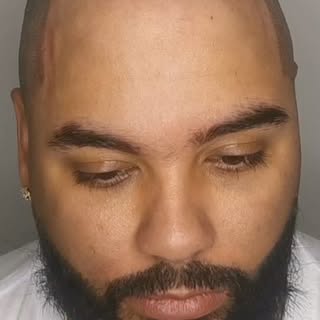 Experiencing hair loss, especially from conditions like Alopecia Areata, can be challenging. Scalp m