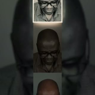 It's amazing what a refined hairline can do to refresh your look and boost your confidence. Scalp mi