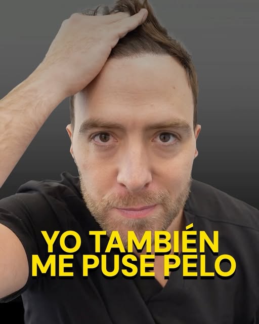 ¡Yo también me puse pelo!
Hoy invito a conocer mi historia de implante capilar. A la hora de elegir 