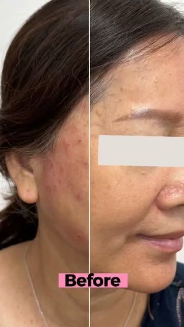 Pores, uneven spots , acne and many more ..

Here we are there for you
..

Book an appointment...

f
