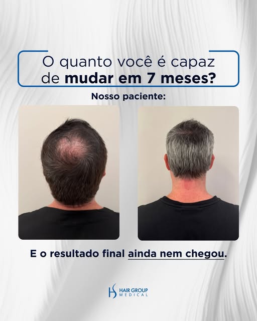 7 meses após o transplante capilar. E ainda tem mais 5 meses de processo pela frente.🤩

Se você bus