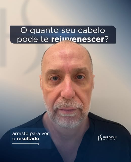 10 meses de pós-operatório, e o processo ainda não terminou!

‌

#transplanteCapilar #santossp #calv