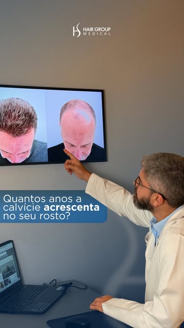 10 meses. Hairline natural, densidade real, resultado indetectável, e os fios ainda estão amadurecen