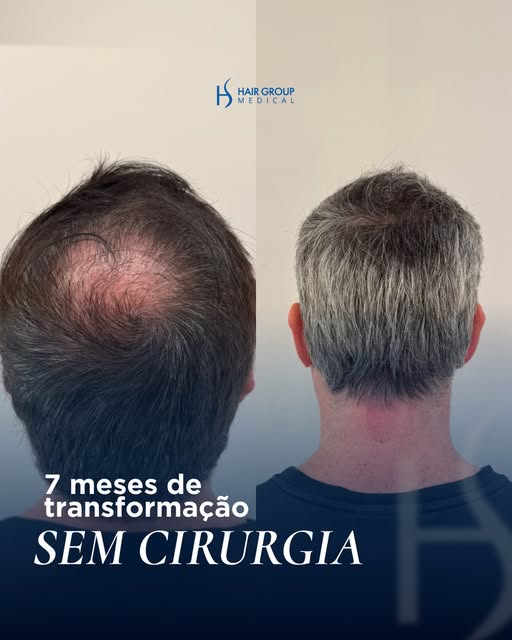O MMP capilar pode ter um papel importante em diferentes momentos do tratamento da rarefação.

Antes