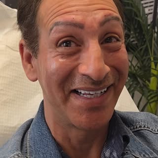 "I love it!" 🥰 Watch this patient's amazing reaction to his 1-year cheek filler results!

In this v