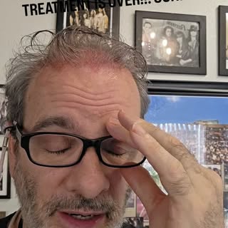 Happy my PRP scalp treatment is over!!