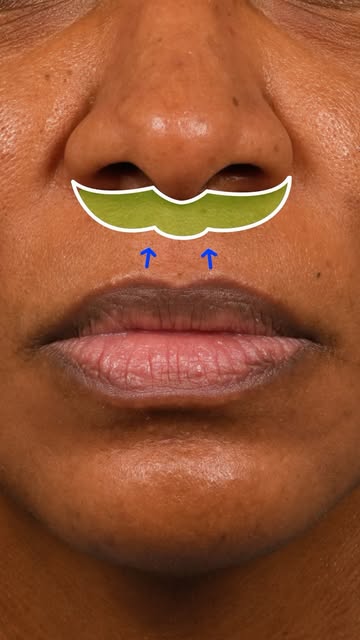 ✨ A 5mm Elelyft lip lift was performed on this beautiful patient, who loves her shorter philtrum and