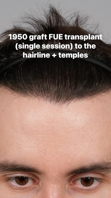 1950 FUE hair transplant in a single session to the hairline and temples.

Notice the improved facia