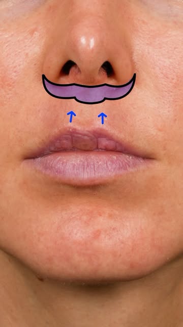 5-month lip lift result ✨

Her starting philtral length was 15mm, and a 5mm Elelyft lip lift was per