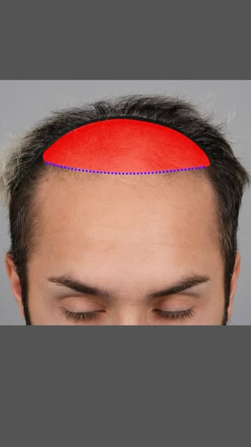 Eight surgeons told him he wasn’t a candidate. 👀

This patient came to us with significant hair los