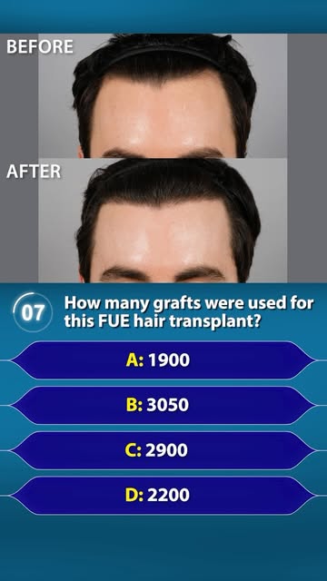 1900 FUE grafts. One session. Natural coverage.

This patient wanted to reduce the size of his foreh