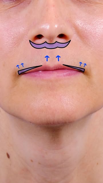 Sometimes improving lip balance takes more than one step. 👄

An Elelyft lip lift was performed firs