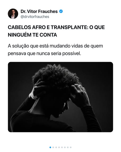 Cabelos afro e transplante: o que ninguém te conta.

A maioria acha que transplante não funciona em 