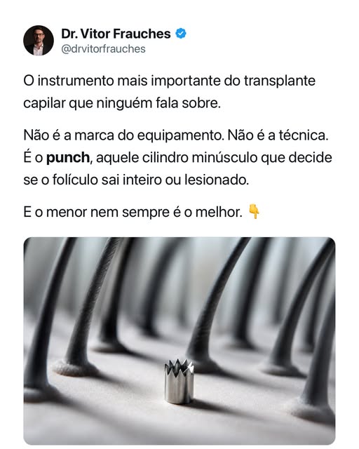 O punch no transplante capilar não é só um instrumento. É a decisão que determina se o folículo sai 