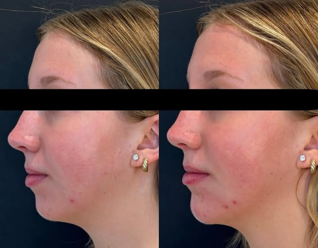 a little chin filler to balance the side profile 🩷
