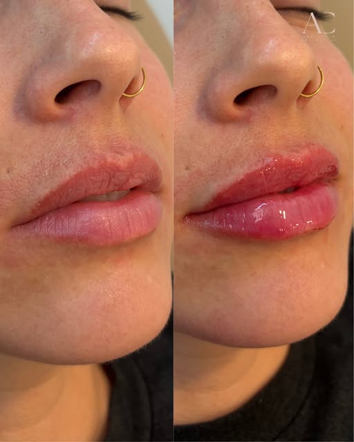 Saturdays are for lippies!! 💋✨

A little enhancement, a whole lot of confidence. 💉💄

Before ➡️ Af