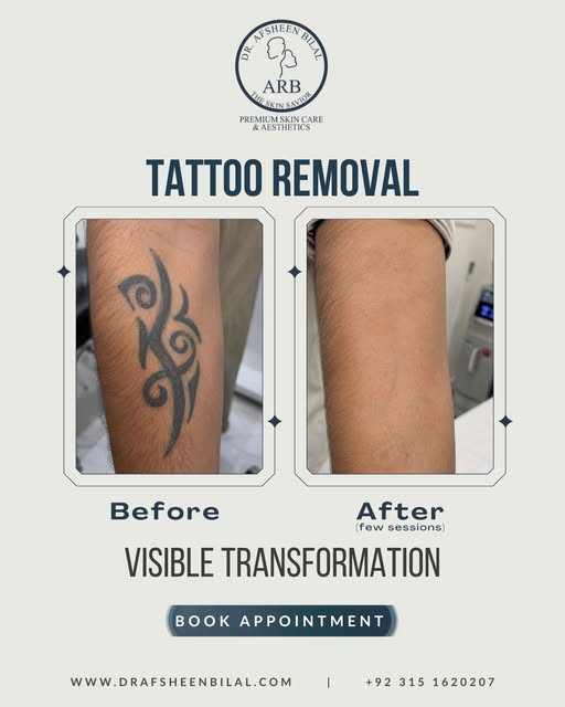 Ready to say goodbye to an old tattoo?

Thinking about Tattoo Removal in Islamabad? Laser tattoo rem