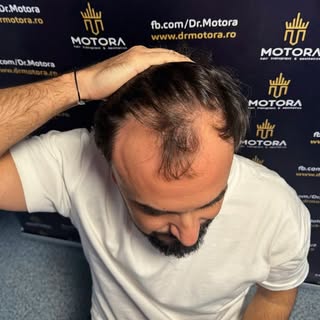 „Bună ziua, vin către dumneavoastră cu un update la păr după 8 luni de la operație. Mulțumesc frumos
