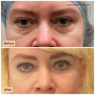 ✨ Lower Lid Blepharoplasty with Fat Transfer ✨

This 48-year-old patient is 3 months post-surgery an