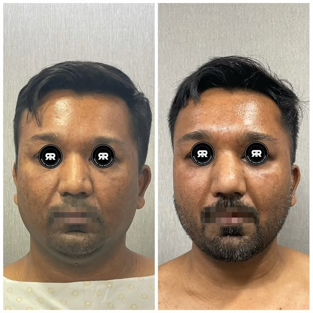 ✨ 𝐀 𝐌𝐨𝐫𝐞 𝐃𝐞𝐟𝐢𝐧𝐞𝐝 𝐋𝐨𝐰𝐞𝐫 𝐅𝐚𝐜𝐞: 𝐁𝐞𝐟𝐨𝐫𝐞 & 𝐀𝐟𝐭𝐞𝐫

This patient underwent 