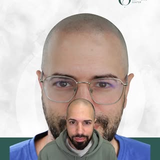 🔳 Micropigmentación capilar efecto rapado – Resultado real 🔳

¿Notas la diferencia? Este es un cla